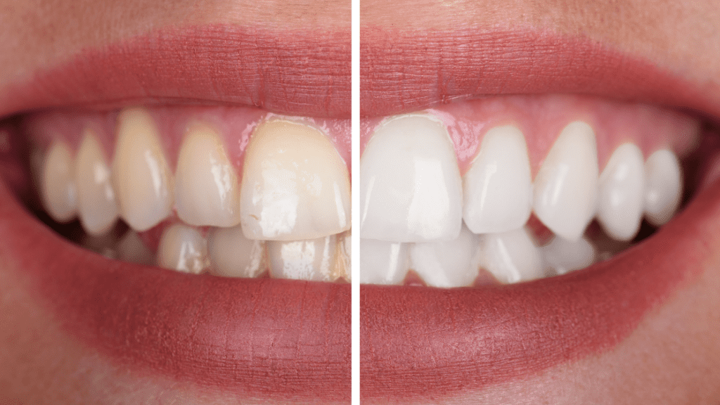 Close up of Woman's Teeth Before And After Whitening